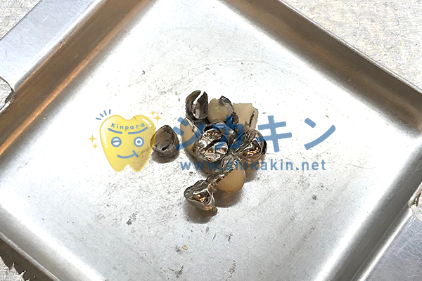 金パラ　20g  撤去冠