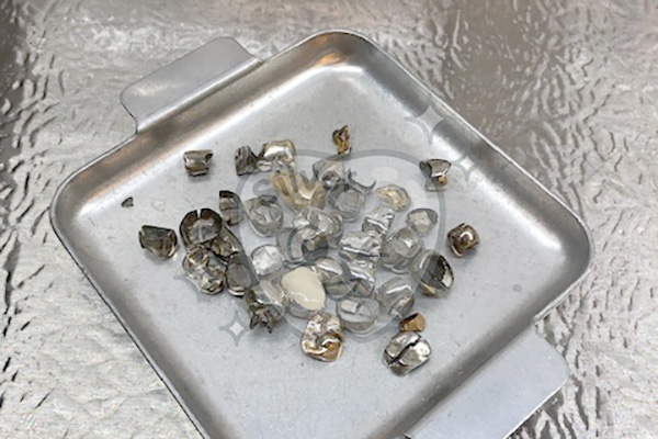 2024年2月5日買取／撤去冠・除去冠｜買取事例｜【シカキン】金パラ  